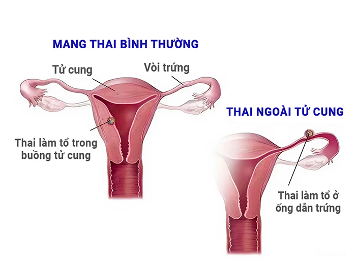 Hình ảnh minh họa mang thai ngoài tử cung.
