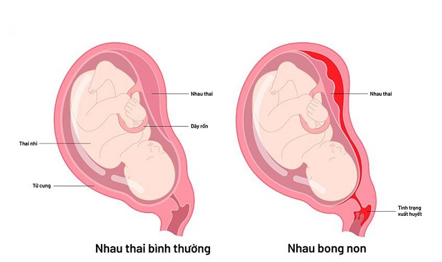 Nhau thai bình thường và nhau thai bong non