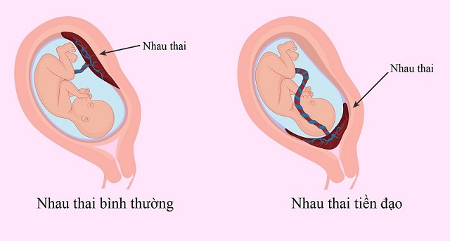 Sự khác biệt giữa nhau thai bình thường và nhau thai tiền đạo.